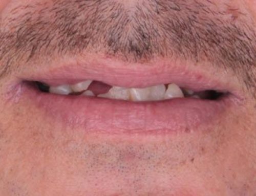 Does a Broken Tooth Require a Dental Implant?