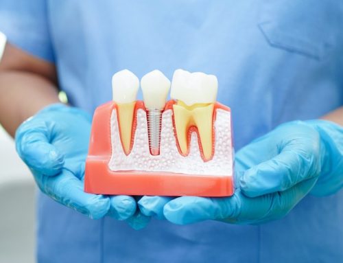 What Are the Most Common Problems with Dental Implants?