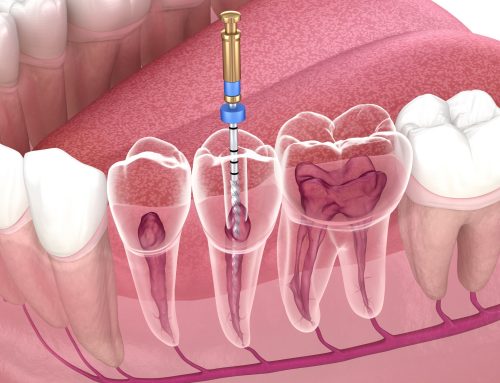 What Is Endodontic Therapy?