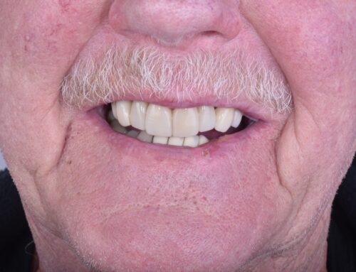Full Mouth Rehabilitation with Dental Implants in Tijuana