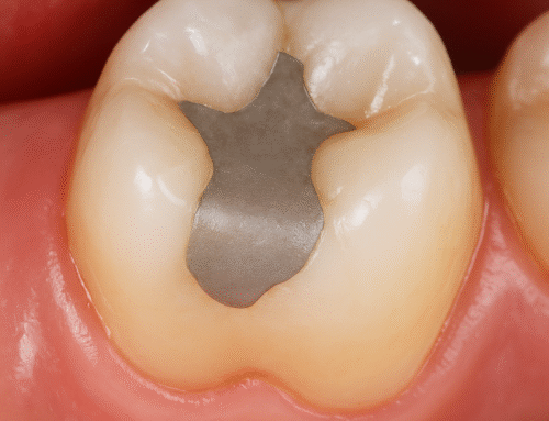 Do Large Tooth Fillings Need a Crown?